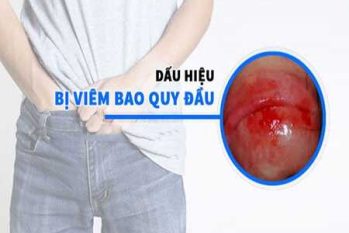 Viêm bao quy đầu có mủ, loét, sưng đỏ? Nhận giải pháp từ chuyên gia!