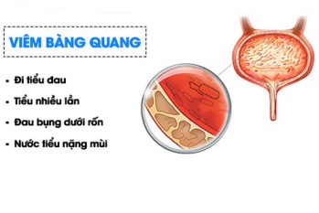 Đừng chủ quan! Tìm hiểu cách trị viêm bàng quang đúng cách để không tái phát