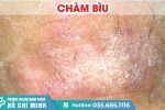 Bệnh chàm bìu là bệnh gì? Có điều trị được không?