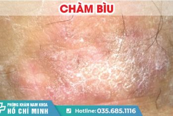 Bệnh chàm bìu là bệnh gì? Có điều trị được không?